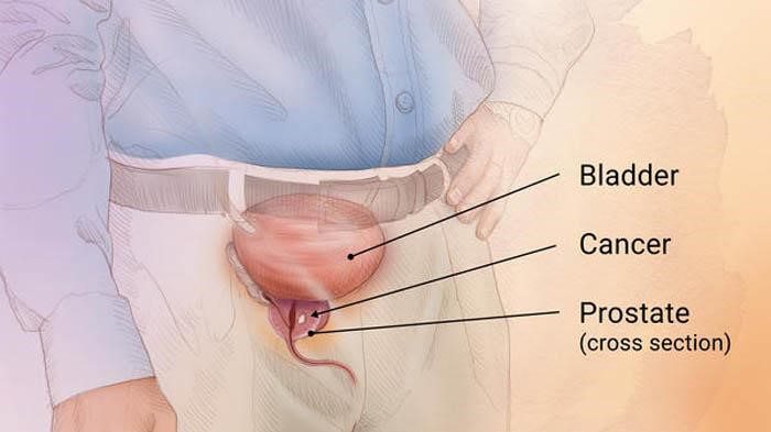 gejala kanker prostat